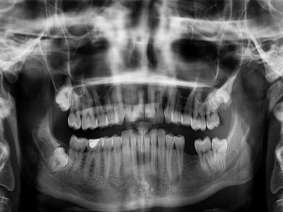 radiografía dientes